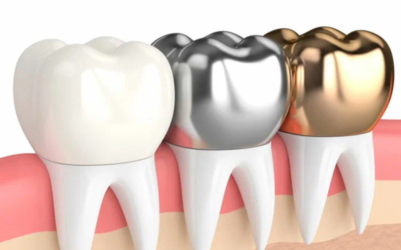 Get Your Dental Crown In Just One Visit